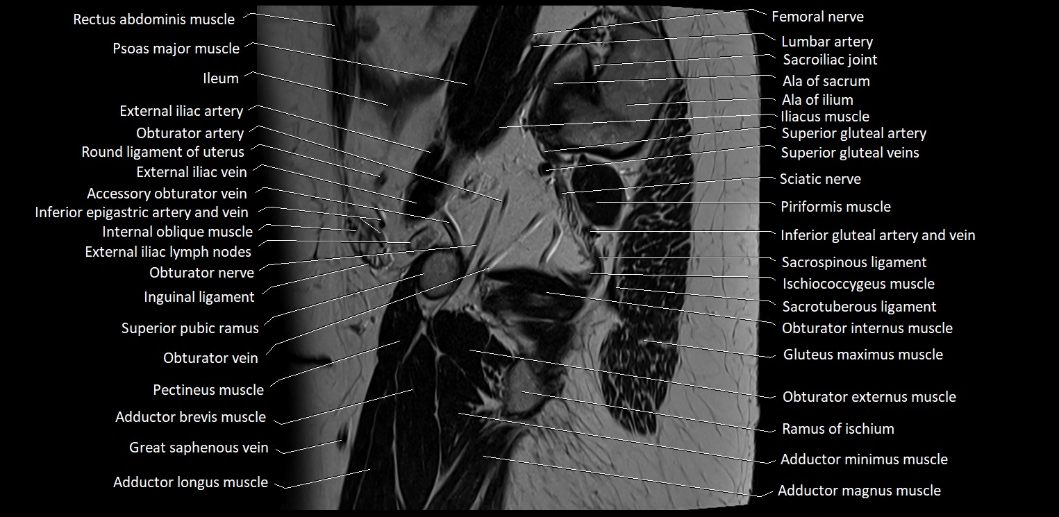 Sagittal cross sectional anatomy of female pelvis (MRI 3T) image 6.webp